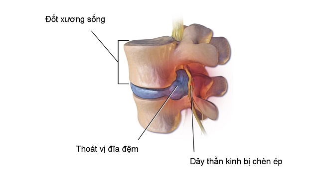 Ghế massage và khả năng hỗ trợ điều trị thoát vị đĩa đệm